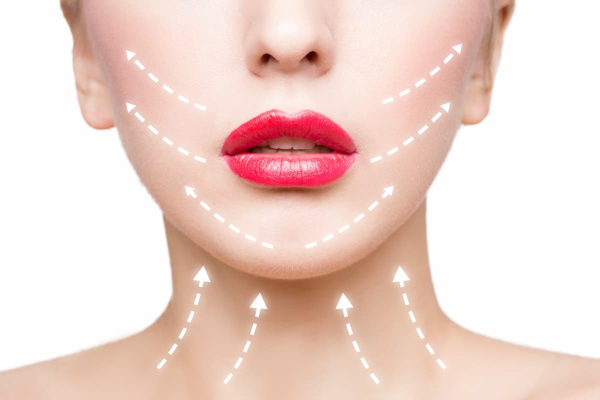 Septoplasty
