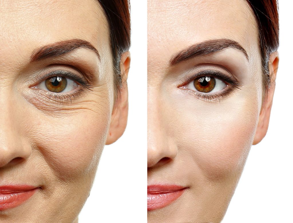 Non-surgical-Face-Lift
